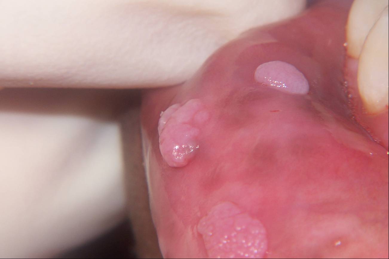 papilloma lower lip)