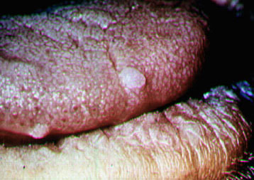 hpv papilloma vírus)