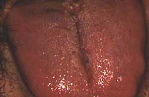  - kaposis_sarcoma_during_therapy_vinblastine_a5