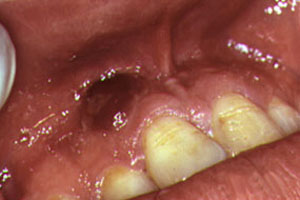  - kaposis_sarcoma_nodular_lesion_pre_treatment_d1