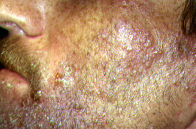 shingles virus images