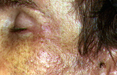 Shingles Picture Image on MedicineNet.com