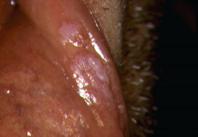 Dermnet: Dermatology Pictures - Skin Disease Pictures