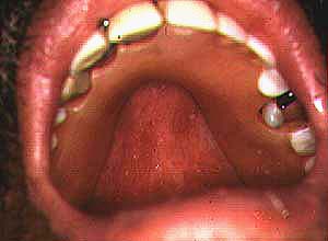  - 015ErythematousCandidiasis