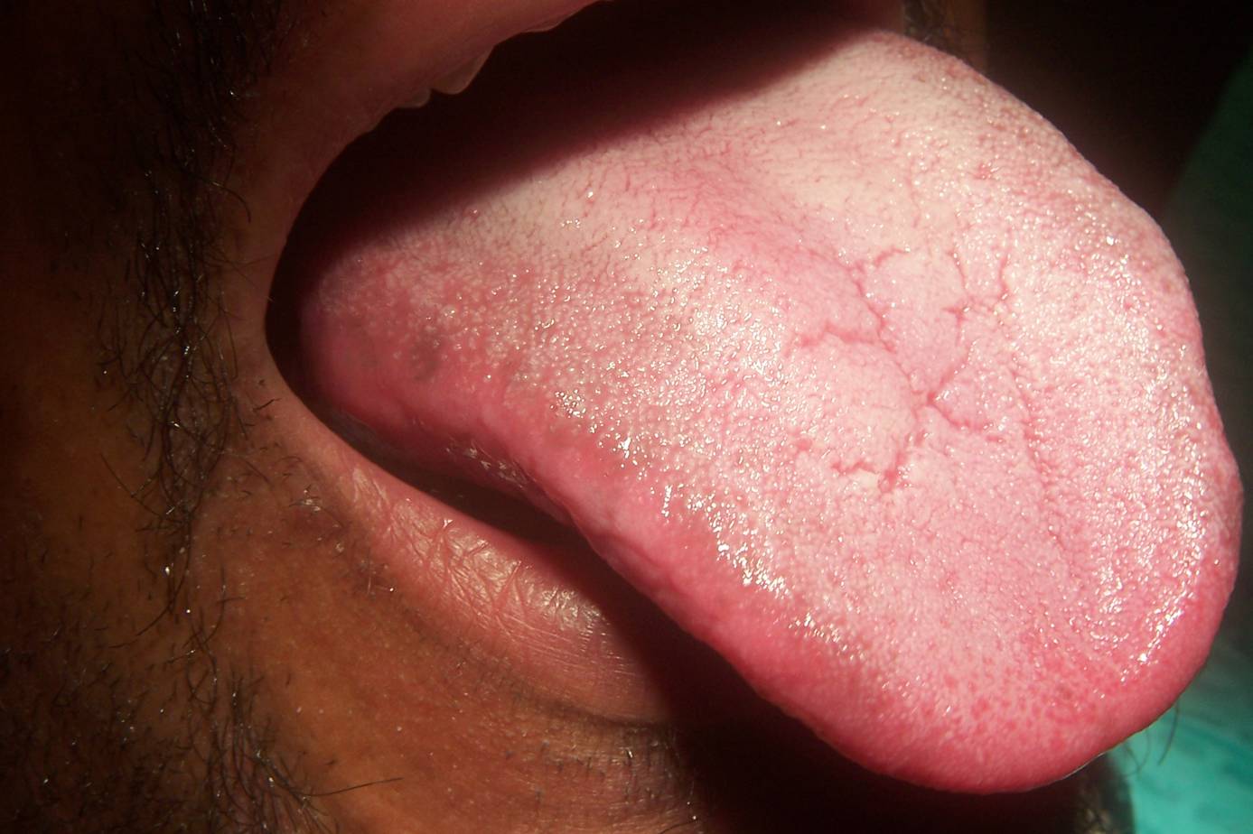 candidiasis #11