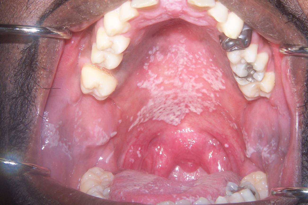 Oral Thrush . Causes, Symptoms & Treatment of oral thrush ...